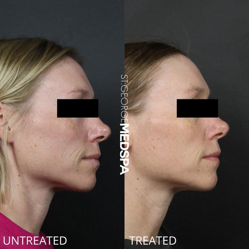 St. George Med Spa microneedling result — St. George, UT