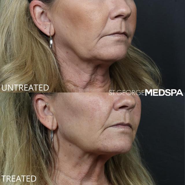 Dermal Fillers result at St. George Med Spa in St. George, UT