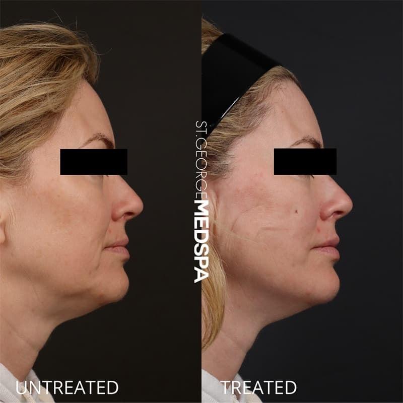 St. George Med Spa skin tightening result — St. George, UT