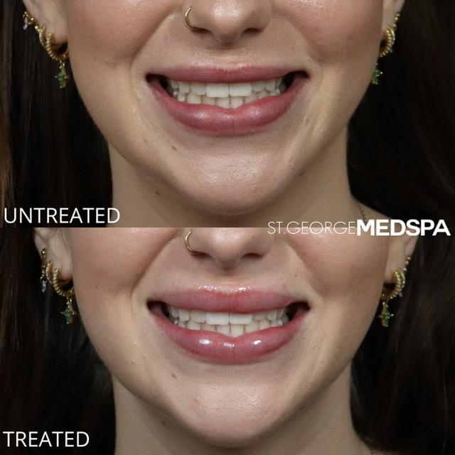Botox result at St. George Med Spa in St. George, UT