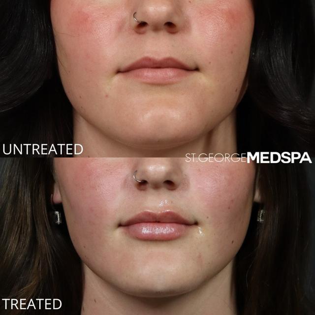 Lip Filler result at St. George Med Spa in St. George, UT