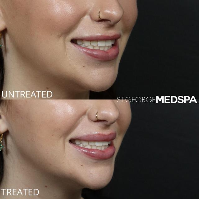Botox result at St. George Med Spa in St. George, UT