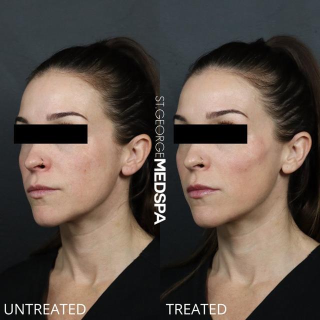 Dermal Fillers result at St. George Med Spa in St. George, UT