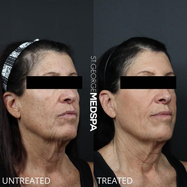 Laser Skin Resurfacing result at St. George Med Spa in St. George, UT