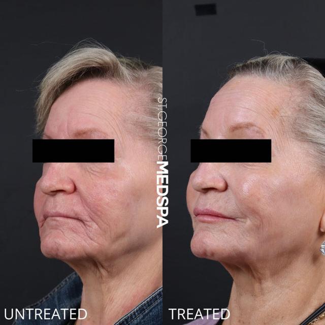 Dermal Fillers result at St. George Med Spa in St. George, UT