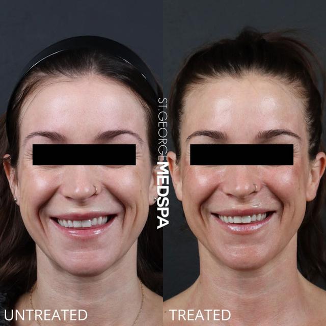 Dermal Fillers result at St. George Med Spa in St. George, UT