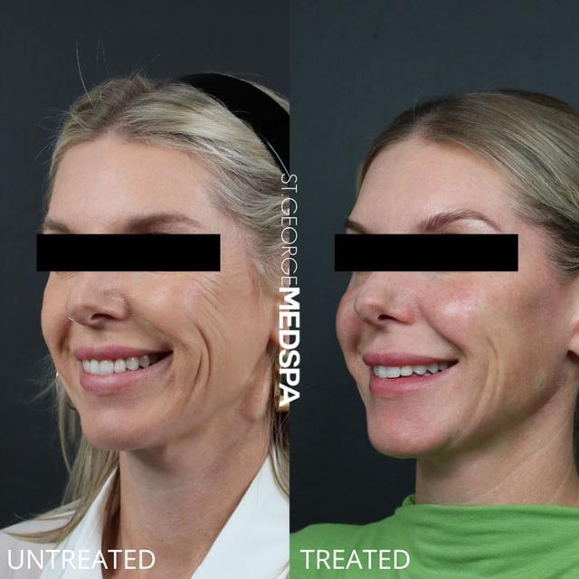 Dermal Fillers result at St. George Med Spa in St. George, UT