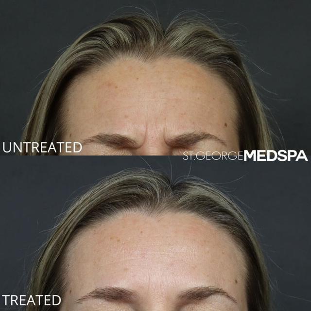 Botox result at St. George Med Spa in St. George, UT