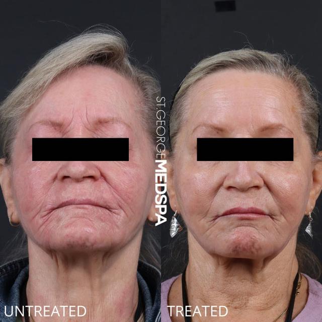 Dermal Fillers result at St. George Med Spa in St. George, UT