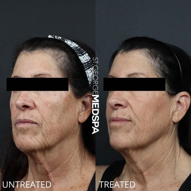 Laser Skin Resurfacing result at St. George Med Spa in St. George, UT