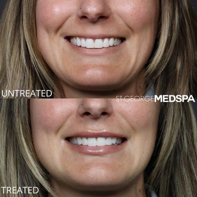 Lip Filler result at St. George Med Spa in St. George, UT