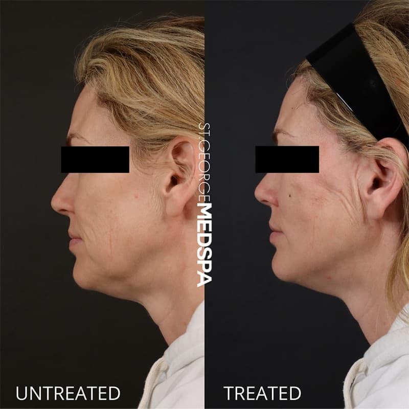 St. George Med Spa skin tightening result — St. George, UT