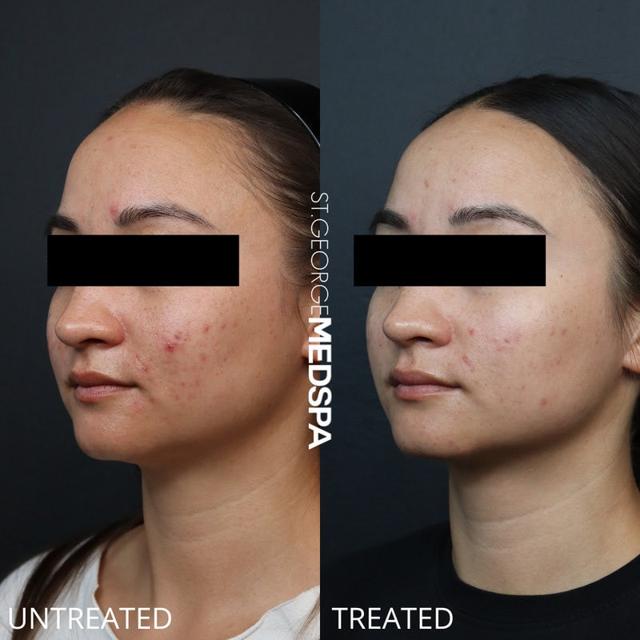 Chemical Peel result at St. George Med Spa in St. George, UT