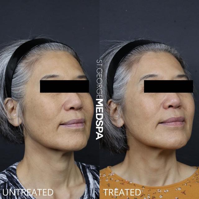 Laser Skin Resurfacing result at St. George Med Spa in St. George, UT