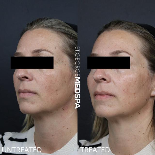 Juvederm result at St. George Med Spa in St. George, UT