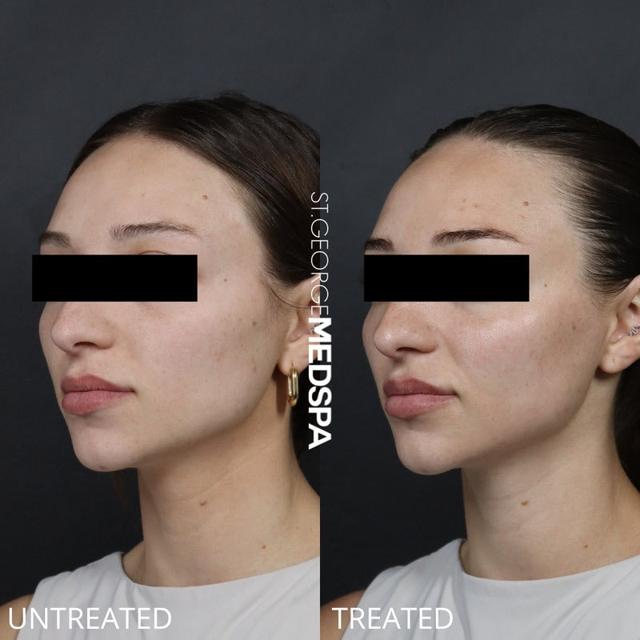 Jawline Filler result at St. George Med Spa in St. George, UT