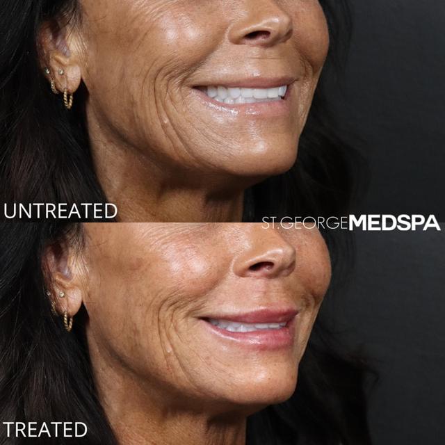 Lip Filler result at St. George Med Spa in St. George, UT