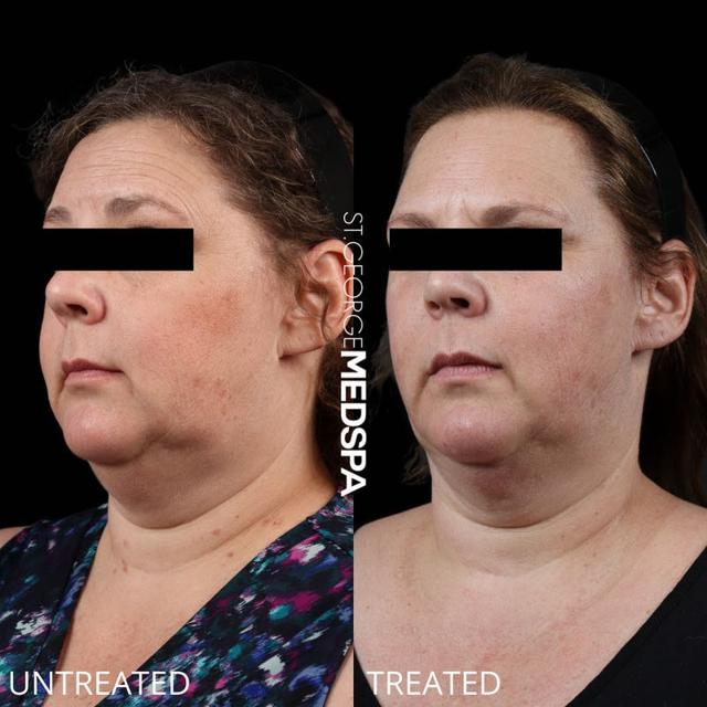 Kybella result at St. George Med Spa in St. George, UT