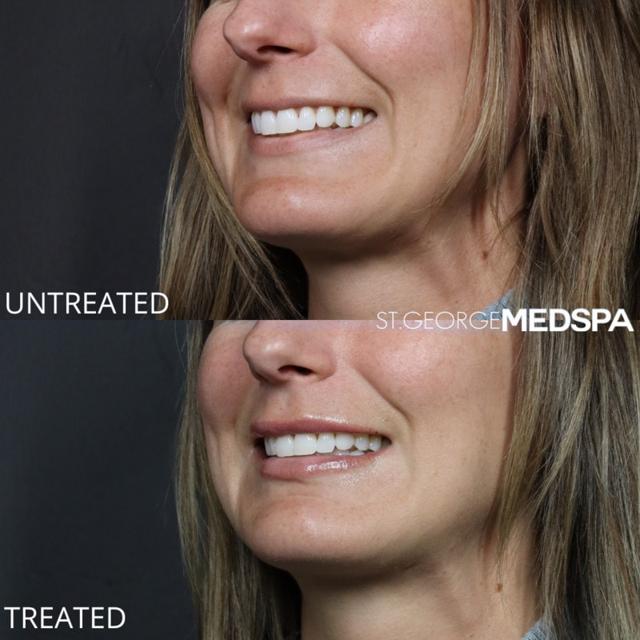 Lip Filler result at St. George Med Spa in St. George, UT