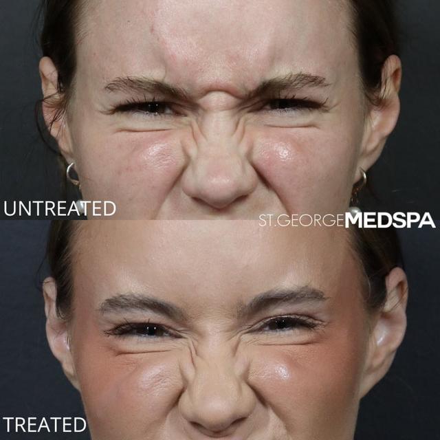 Botox result at St. George Med Spa in St. George, UT
