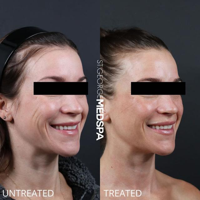 Dermal Fillers result at St. George Med Spa in St. George, UT