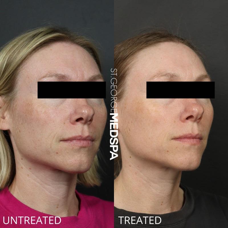 St. George Med Spa microneedling result — St. George, UT