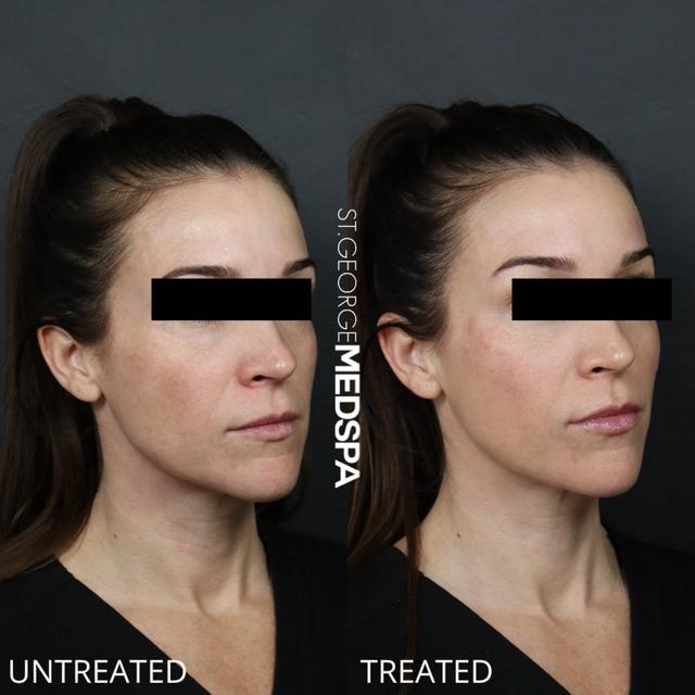 Dermal Fillers result at St. George Med Spa in St. George, UT