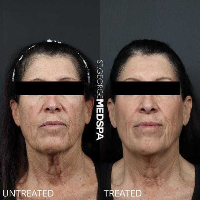 Laser Skin Resurfacing result at St. George Med Spa in St. George, UT