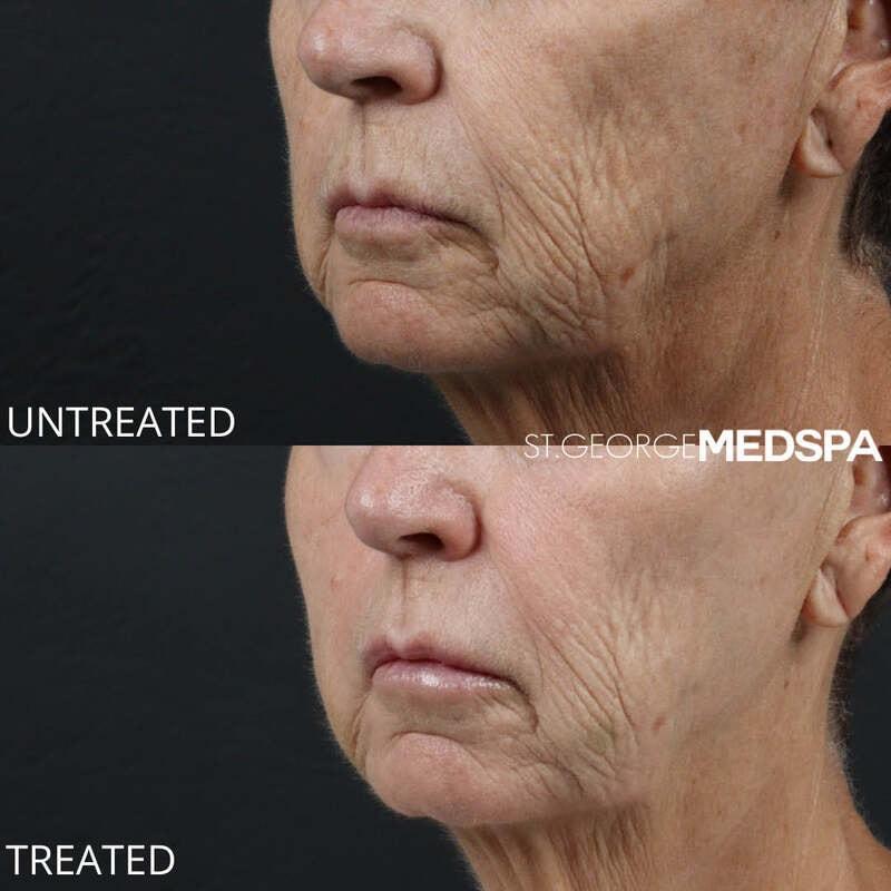 St. George Med Spa skin tightening result — St. George, UT