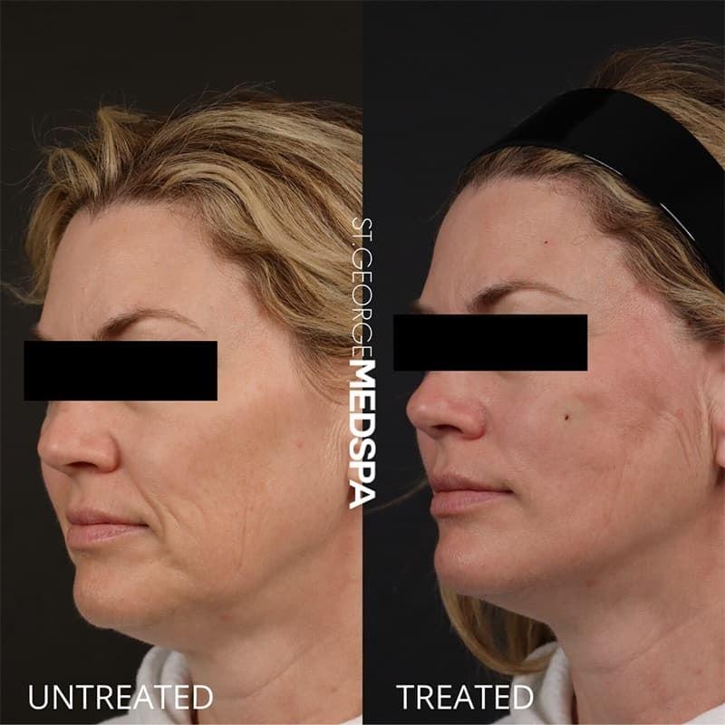 St. George Med Spa skin tightening result — St. George, UT