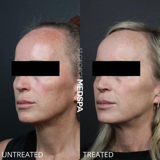 Laser Skin Resurfacing result at St. George Med Spa in St. George, UT
