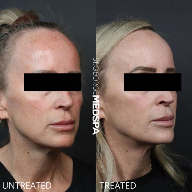 Laser Skin Resurfacing result at St. George Med Spa in St. George, UT