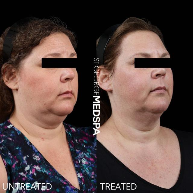 Kybella result at St. George Med Spa in St. George, UT