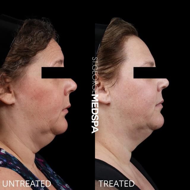 Kybella result at St. George Med Spa in St. George, UT