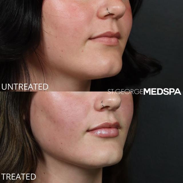 Lip Filler result at St. George Med Spa in St. George, UT