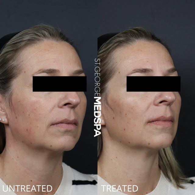 Jawline Filler result at St. George Med Spa in St. George, UT