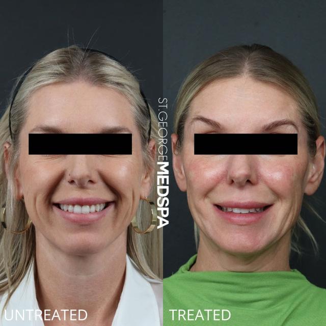 Dermal Fillers result at St. George Med Spa in St. George, UT