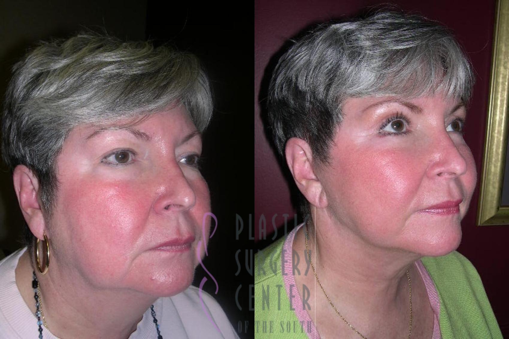 Plastic Surgery Center of the South neck lift result — Marietta, GA