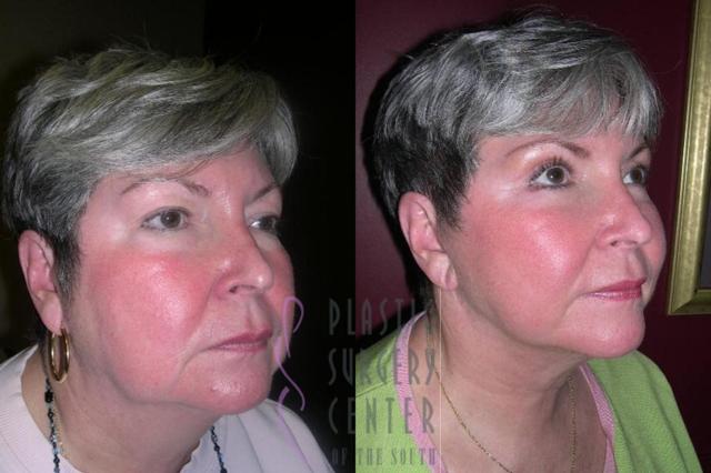 Neck Lift result at Plastic Surgery Center of the South in Marietta, GA