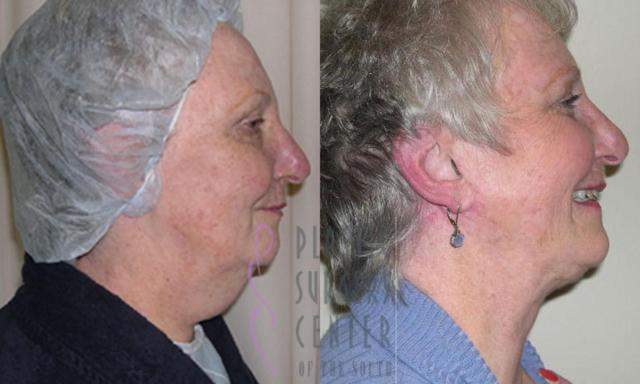 Neck Lift result at Plastic Surgery Center of the South in Marietta, GA