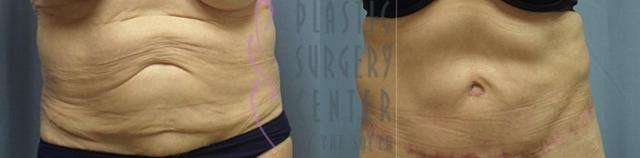 Tummy Tuck result at Plastic Surgery Center of the South in Marietta, GA