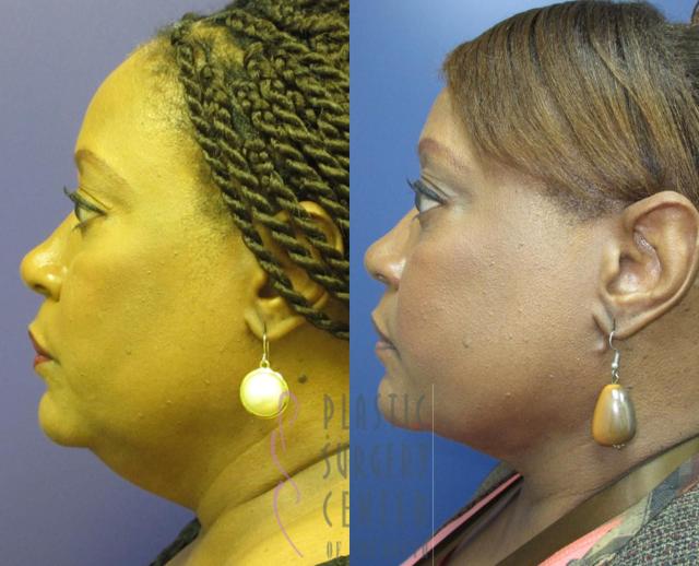 Neck Lift result at Plastic Surgery Center of the South in Marietta, GA