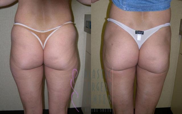 Liposuction result at Plastic Surgery Center of the South in Marietta, GA