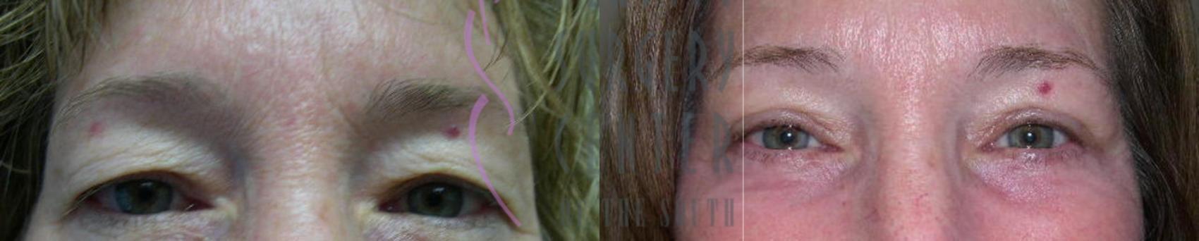 Plastic Surgery Center of the South blepharoplasty result — Marietta, GA