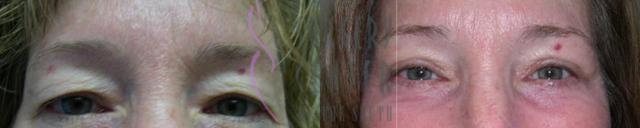 Blepharoplasty result at Plastic Surgery Center of the South in Marietta, GA
