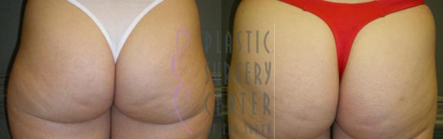Liposuction result at Plastic Surgery Center of the South in Marietta, GA
