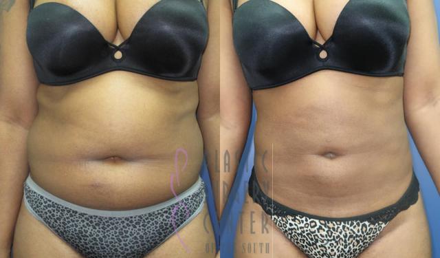 Liposuction result at Plastic Surgery Center of the South in Marietta, GA