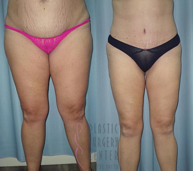 Liposuction result at Plastic Surgery Center of the South in Marietta, GA
