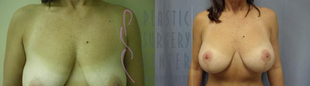Mommy Makeover result at Plastic Surgery Center of the South in Marietta, GA