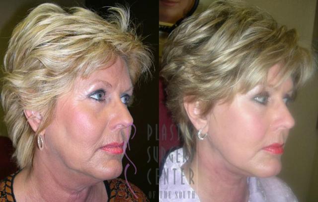 Neck Lift result at Plastic Surgery Center of the South in Marietta, GA